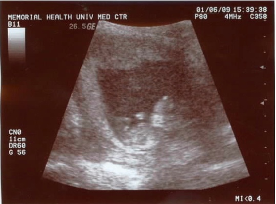 11-12 weeks 11-12 weeks