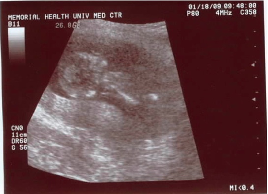13-14 weeks 13-14 weeks