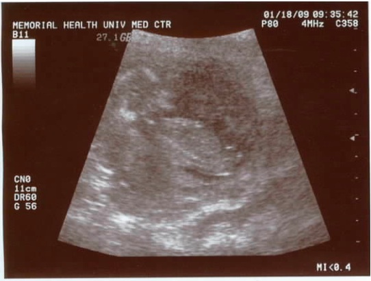 13-14 weeks 13-14 weeks